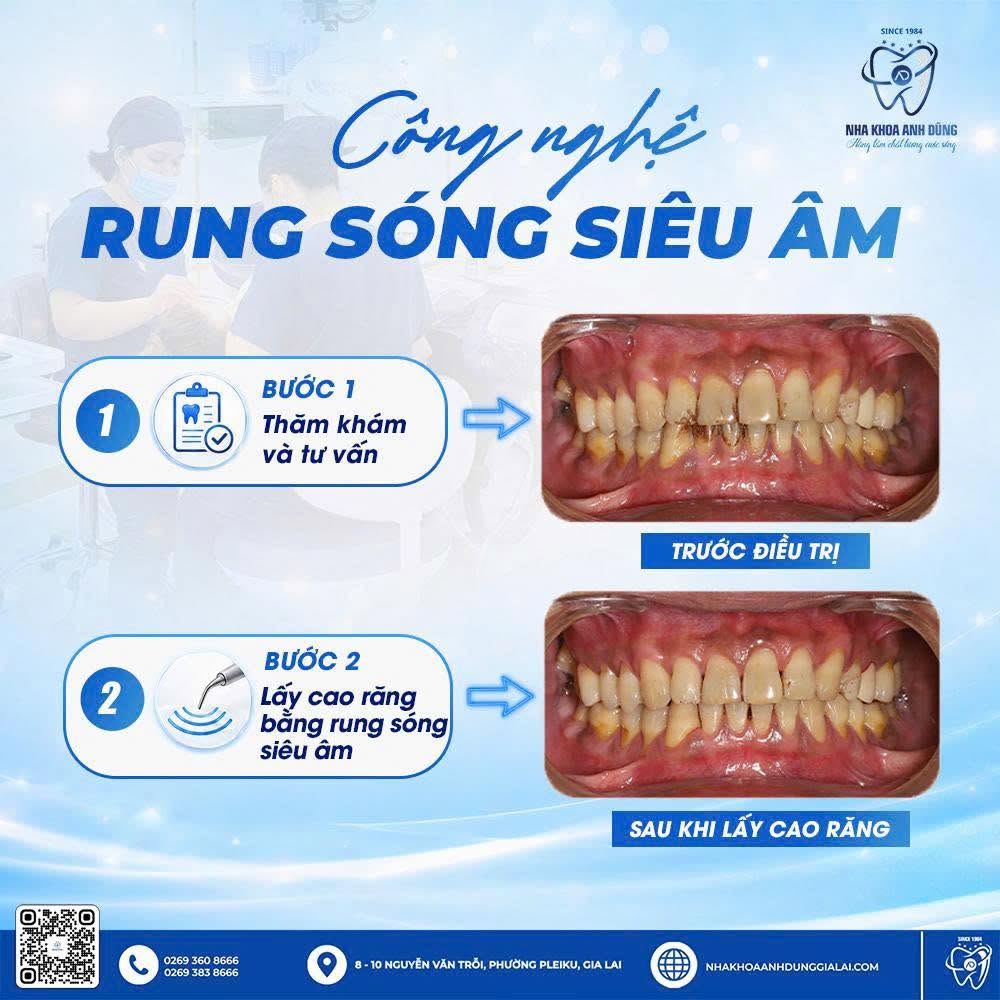 thoi-cat-sinh-hoc-air-polishing