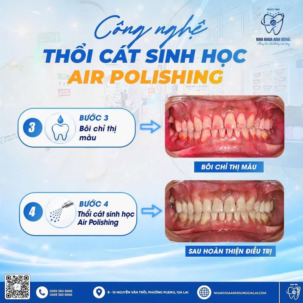 thoi-cat-sinh-hoc-air-polishing